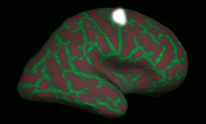 figure 1 - patient cb's brain